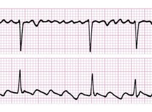 Fibrilación auricular.