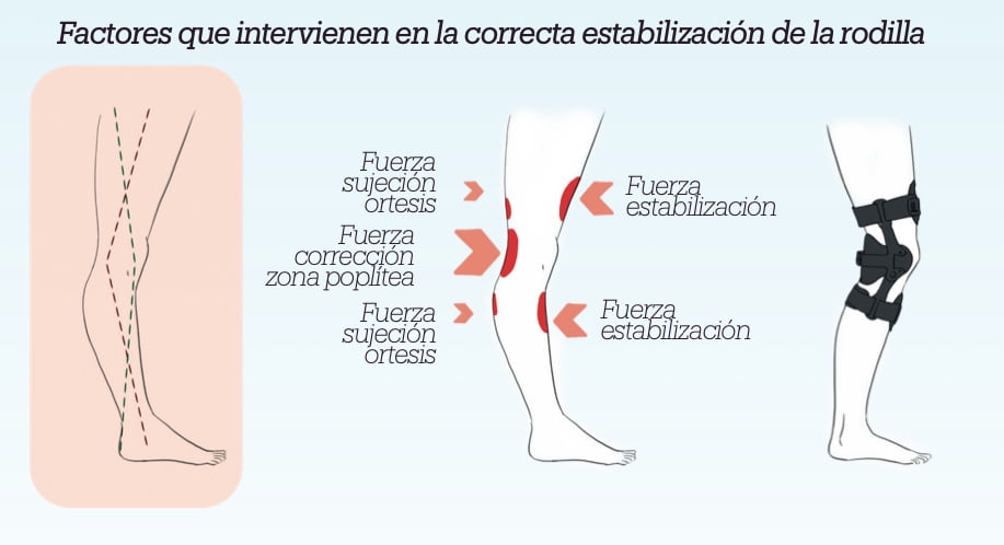 Órtesis para control Genu recurvatum. Factores
